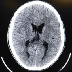 tomografia komputerowa głowy