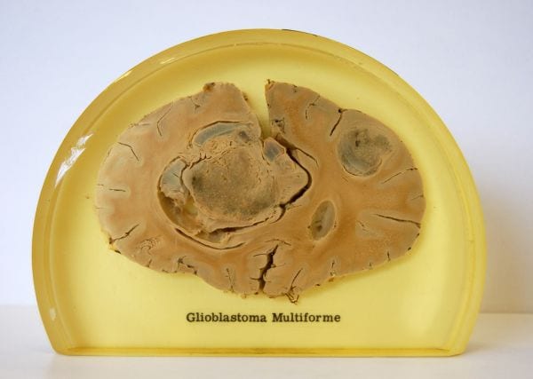 glejak wielopostaciowy glioblastoma multiforme GBM